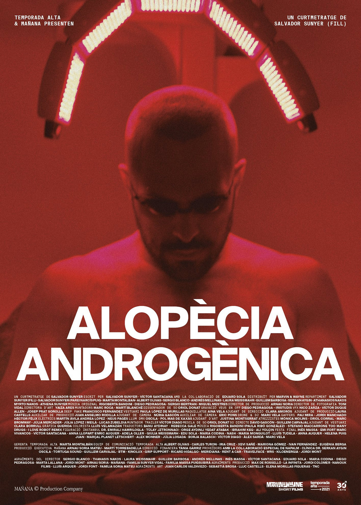 Alopècia Androgènica